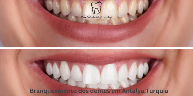 Branqueamento dos dentes em Antalya,Turquia