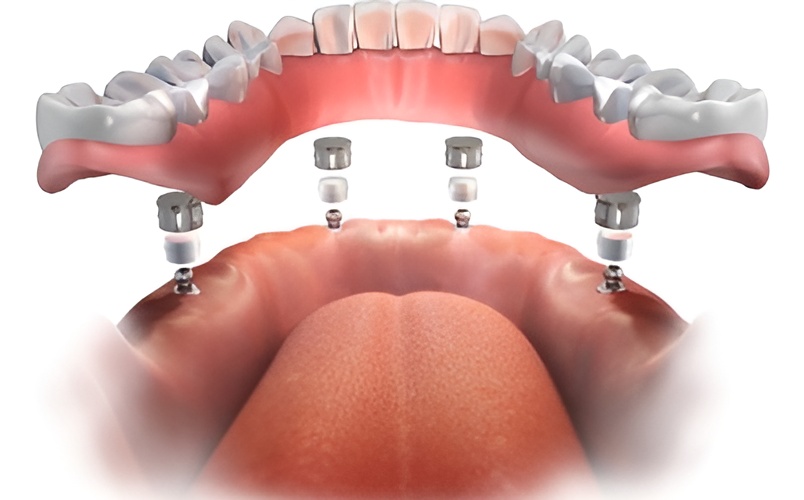 All on 4 Dental Implant illustration