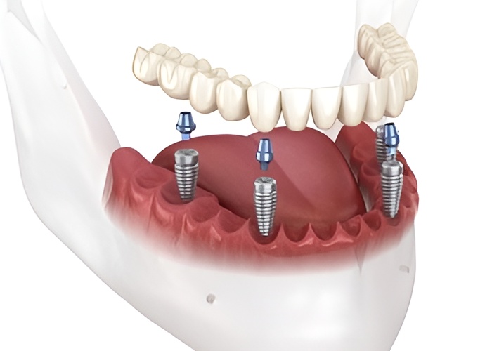 All on 4 Dental Implant illustration