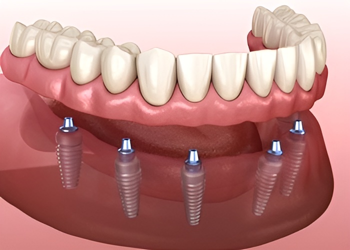 All on 6 Dental Implant illustration