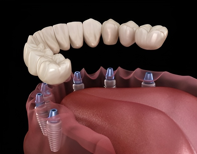 All on 6 Dental Implant illustration