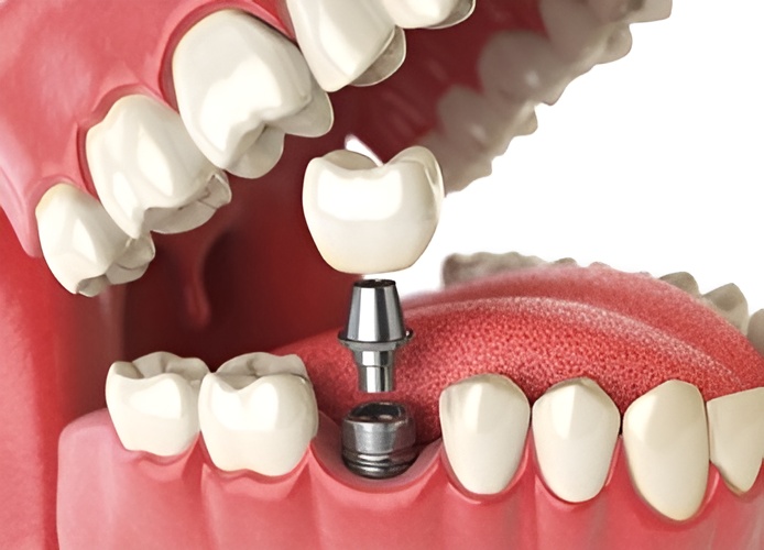 Tooth Implant implant