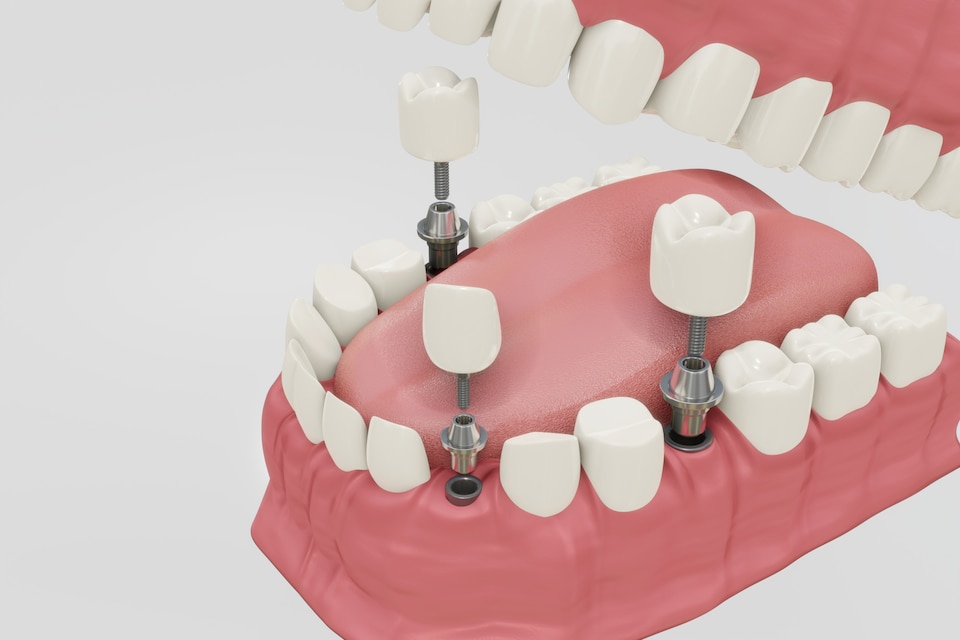 Dental Implant illustration