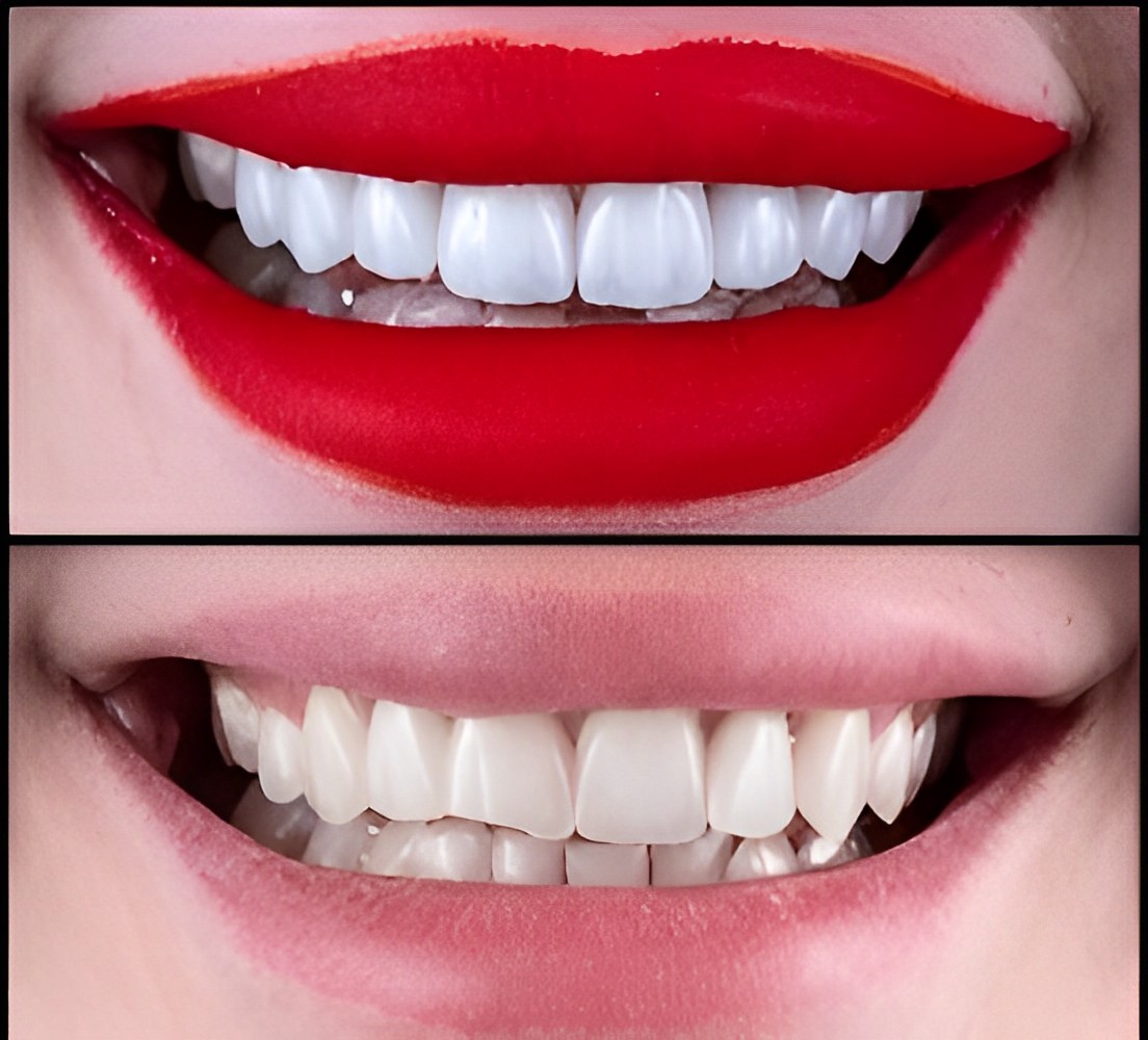 emax veneer