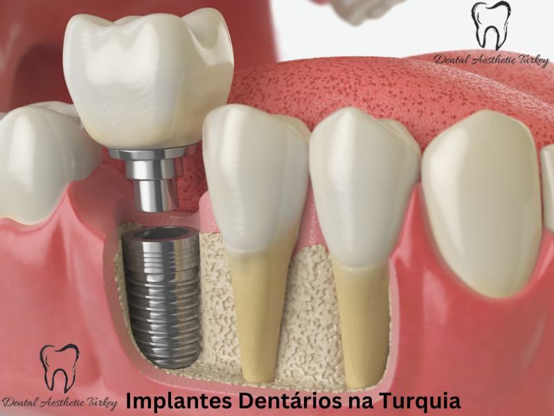 implantes dentários na Turquia