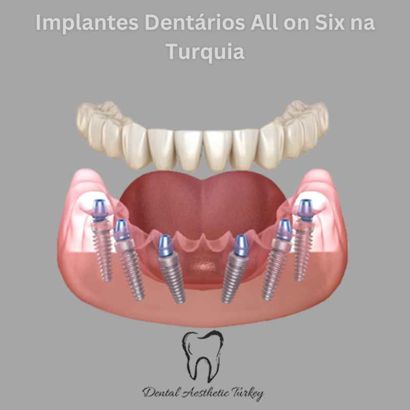 Implante dentário All On 6 em Turquia