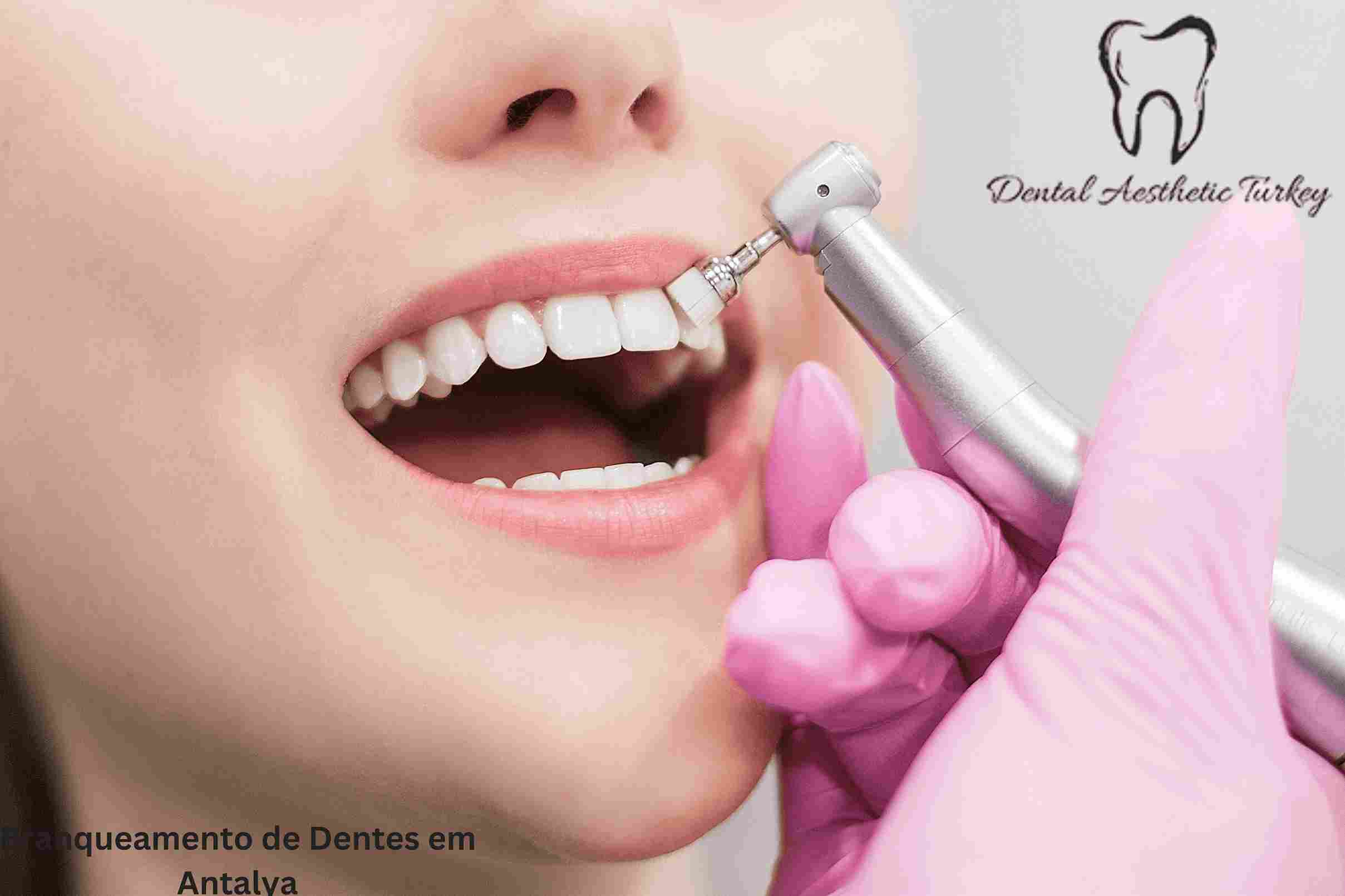 Branqueamento de Dentes em Antalya