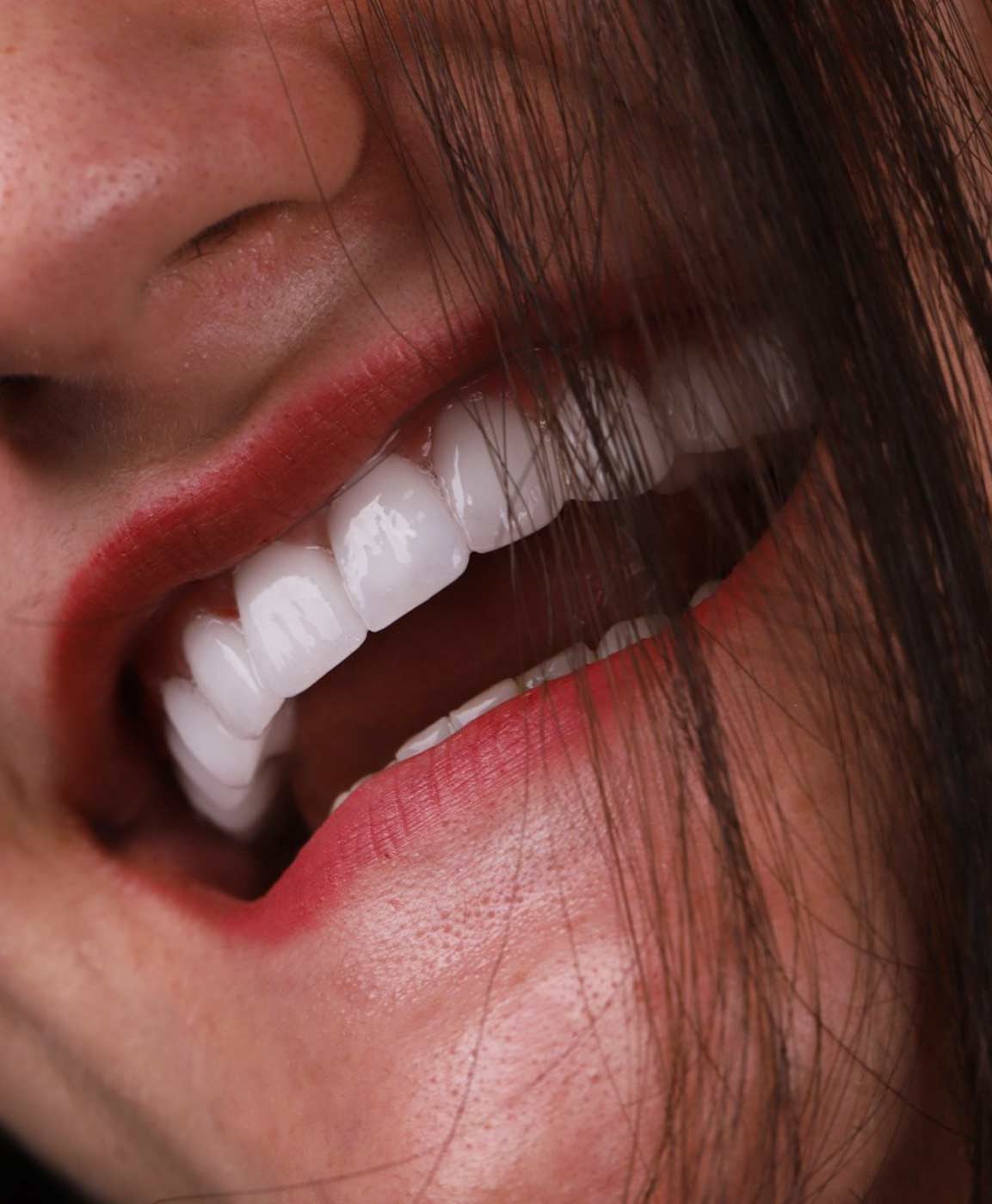 implantes-dentarios-turquia-1