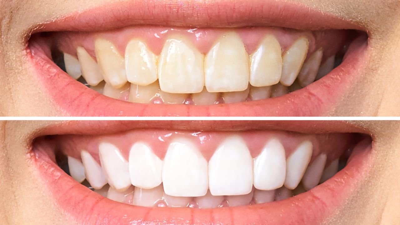Clareamento Dental: Laser ou LED Caseiro?