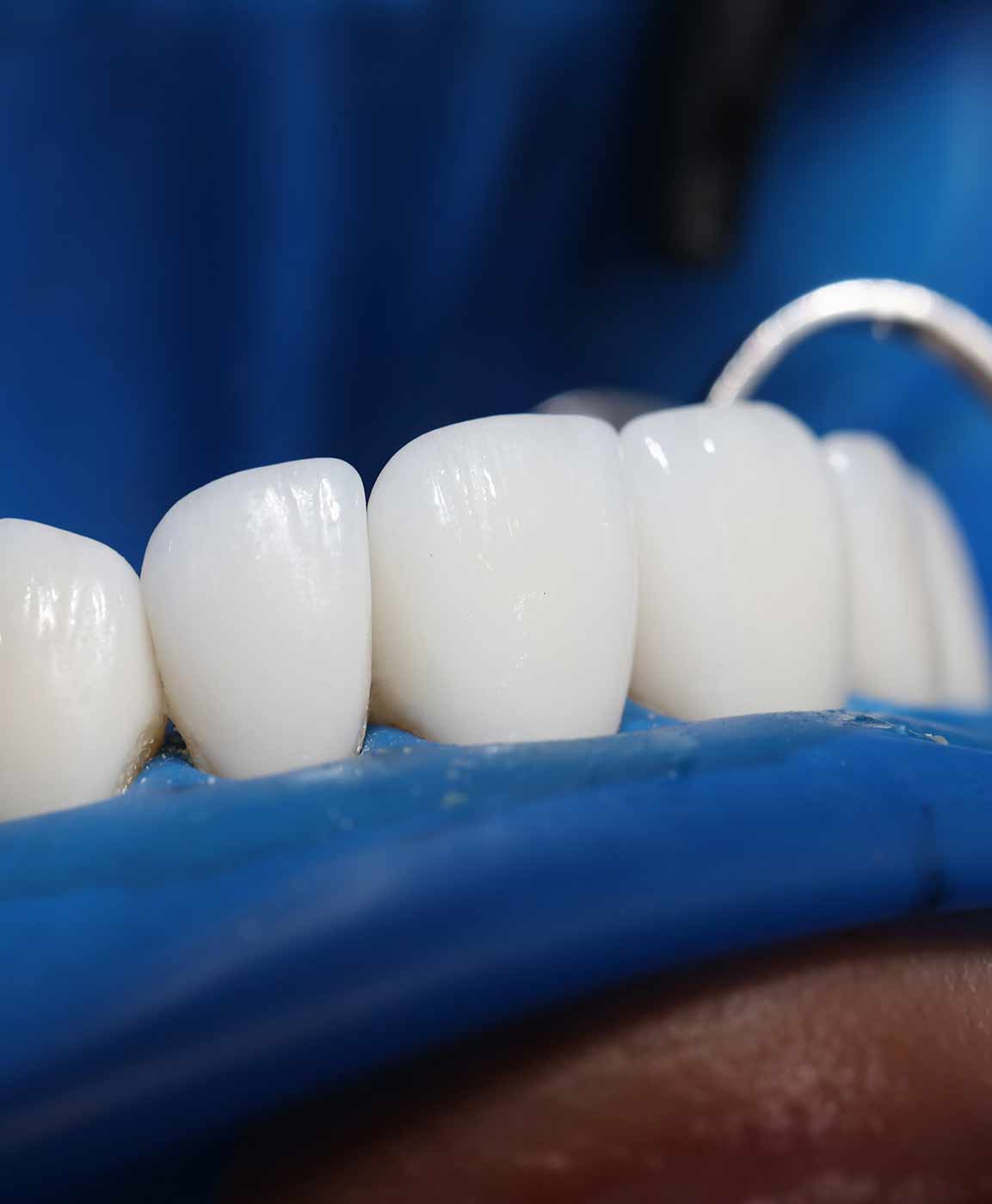 implantes-dentarios-turquia-1